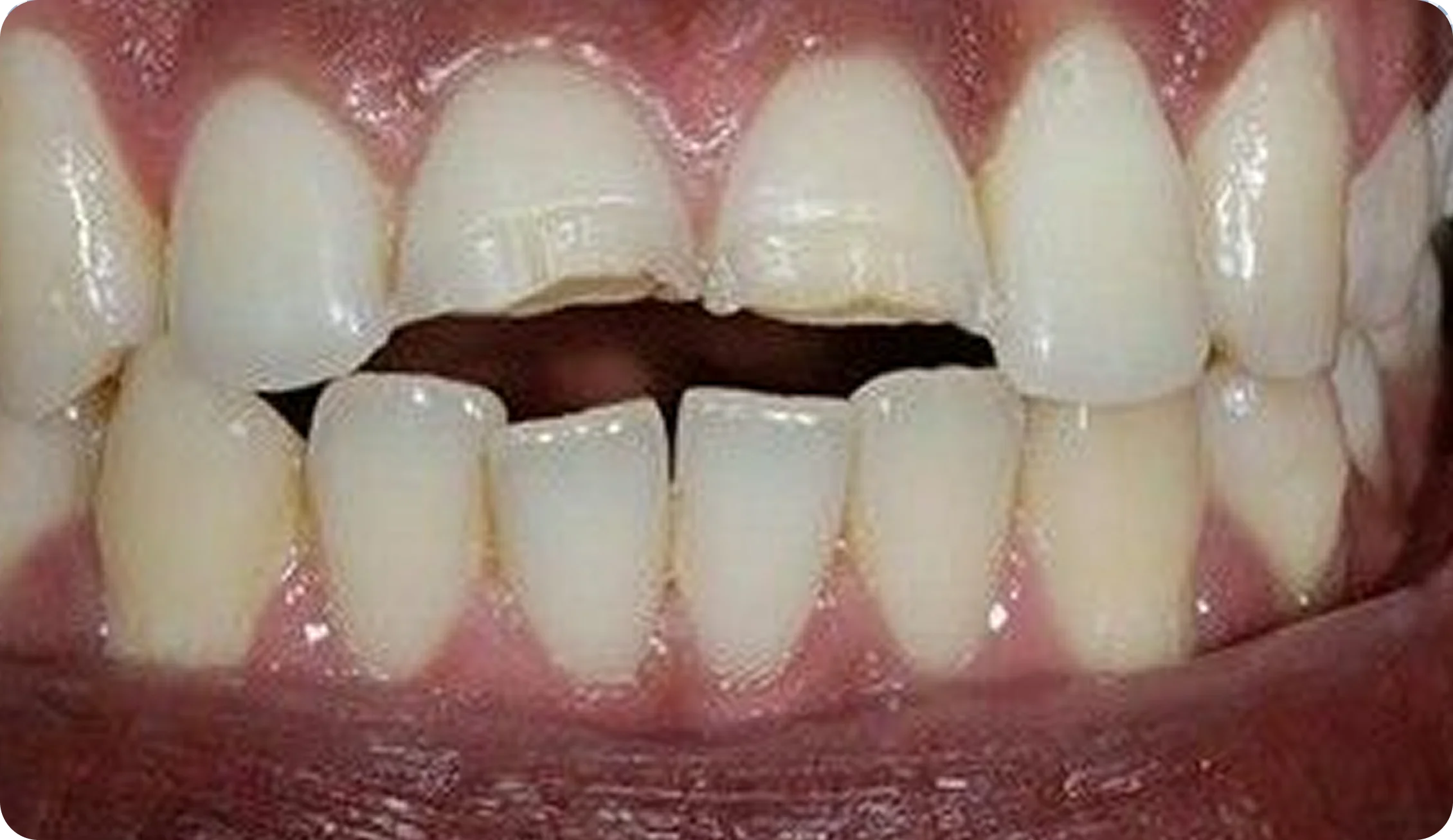 Crowns_and_Onlays_image_6