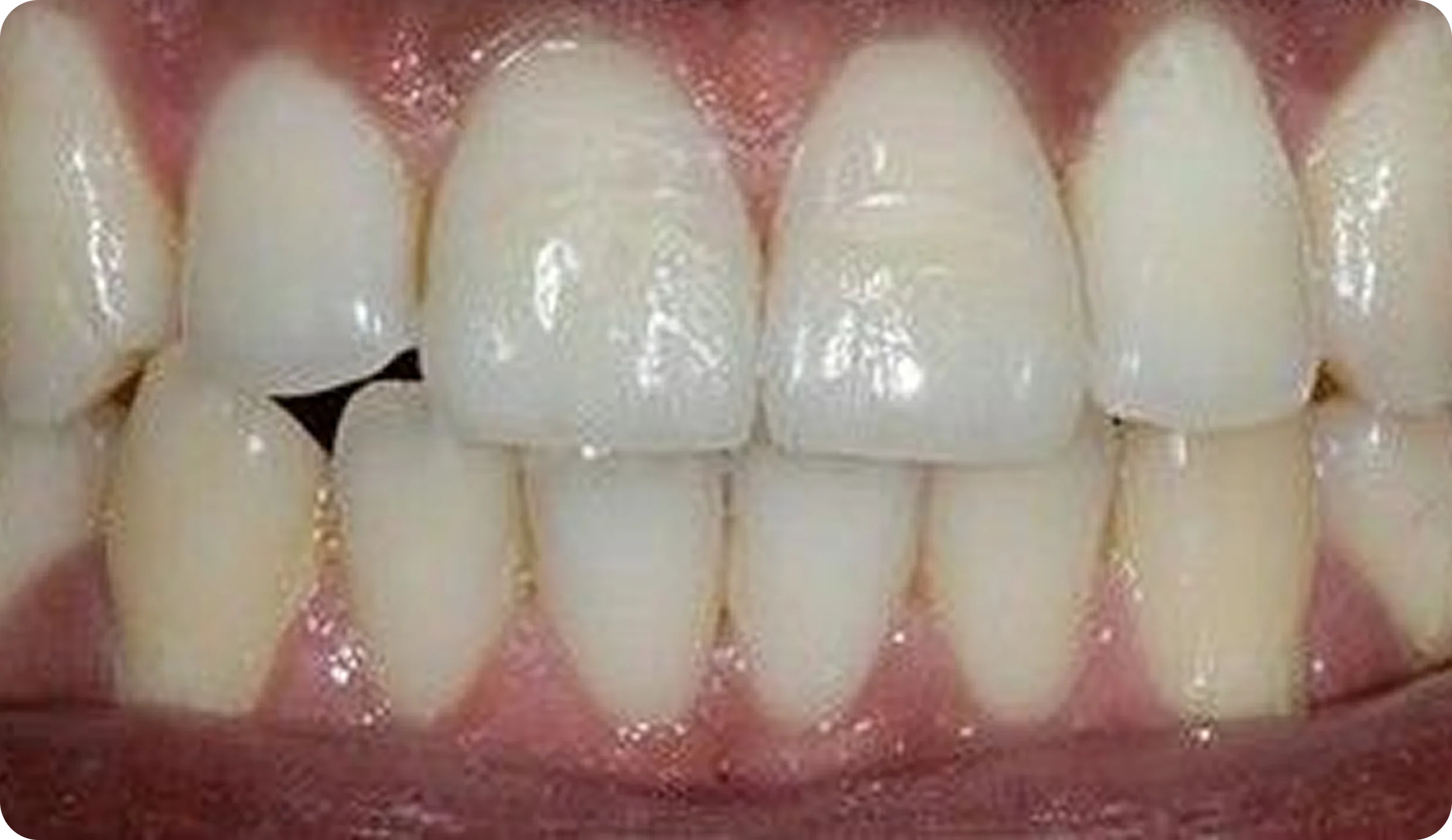 Crowns_and_Onlays_image_7