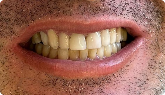Dental Implant After