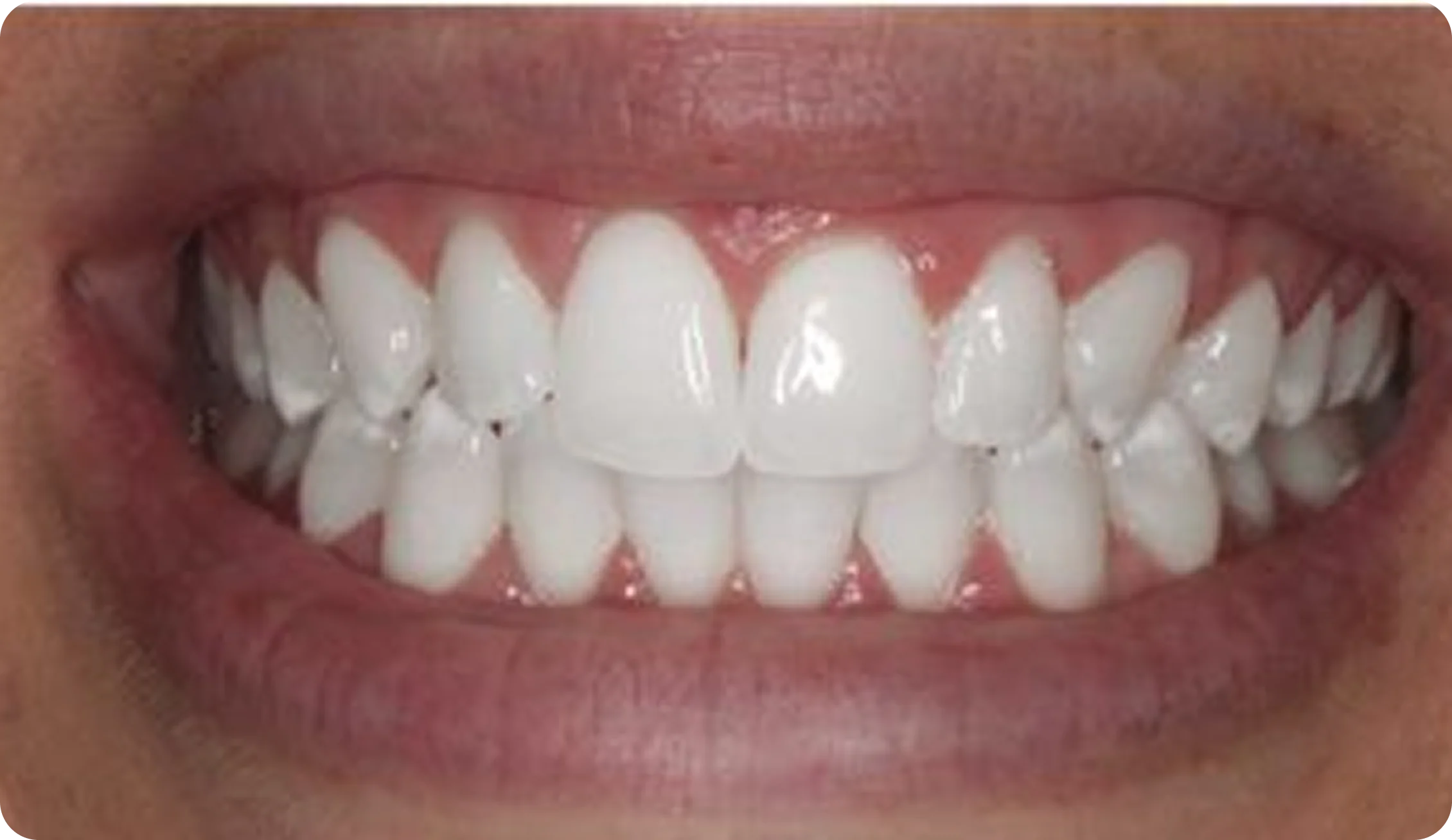 Dental_Hygiene_After