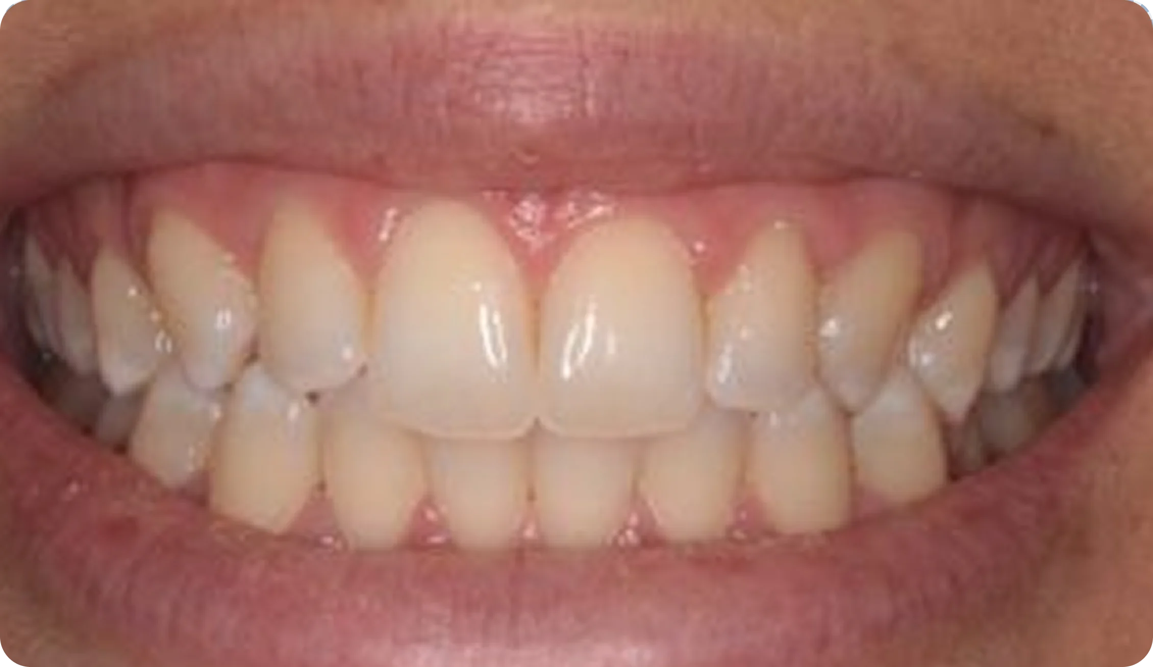 Dental_Hygiene_before Dental_Hygiene_before