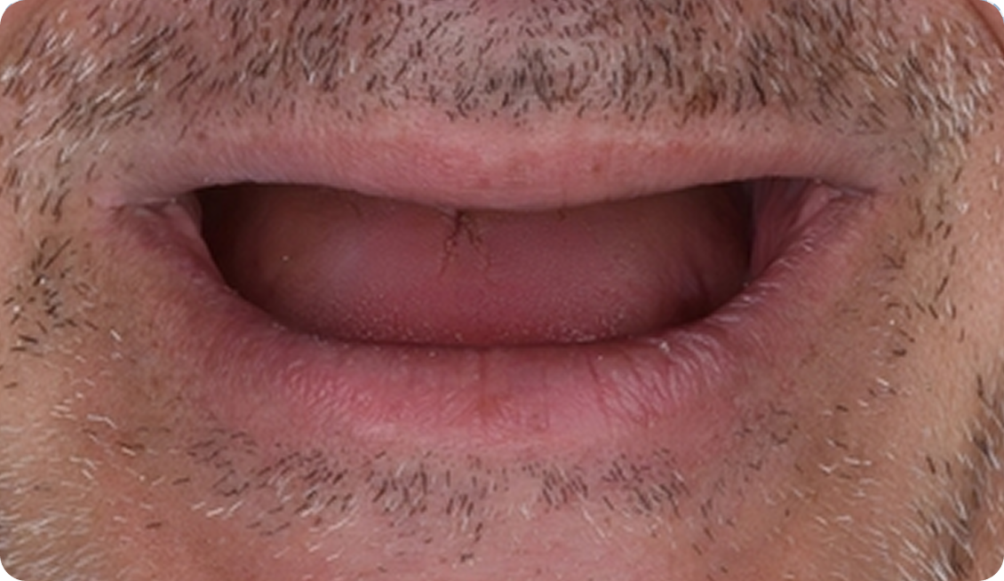 Dentures image 6 Before