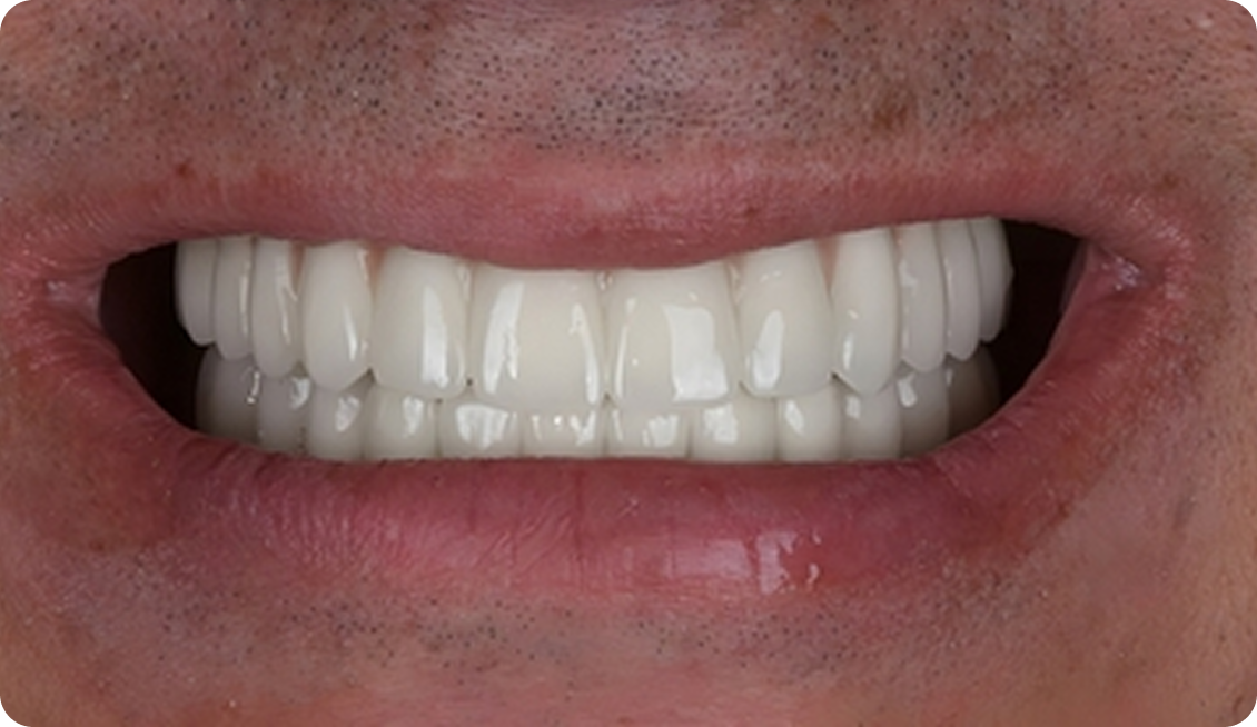 Dentures image 7 After