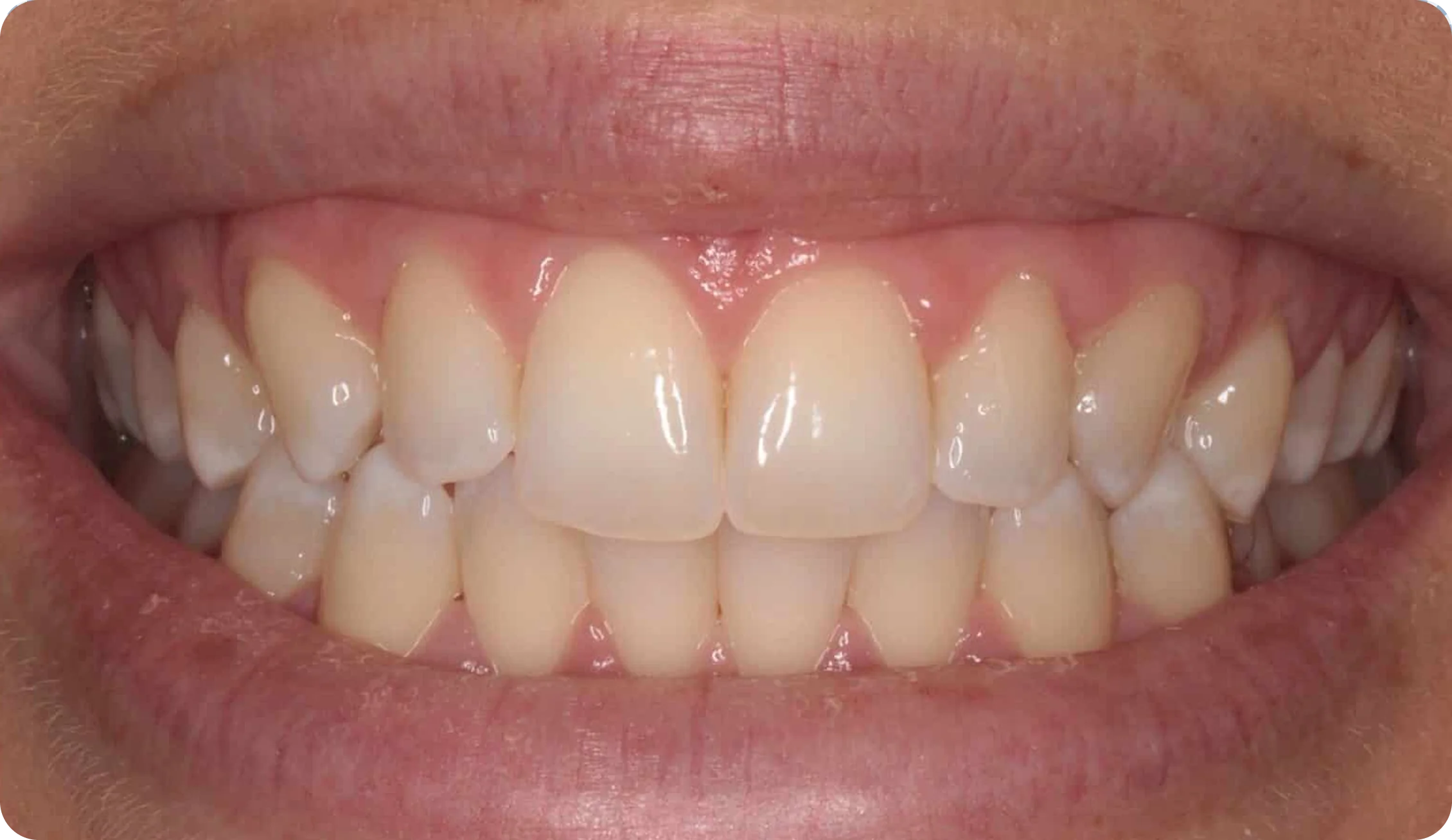 Teeth_Whitening_image_6