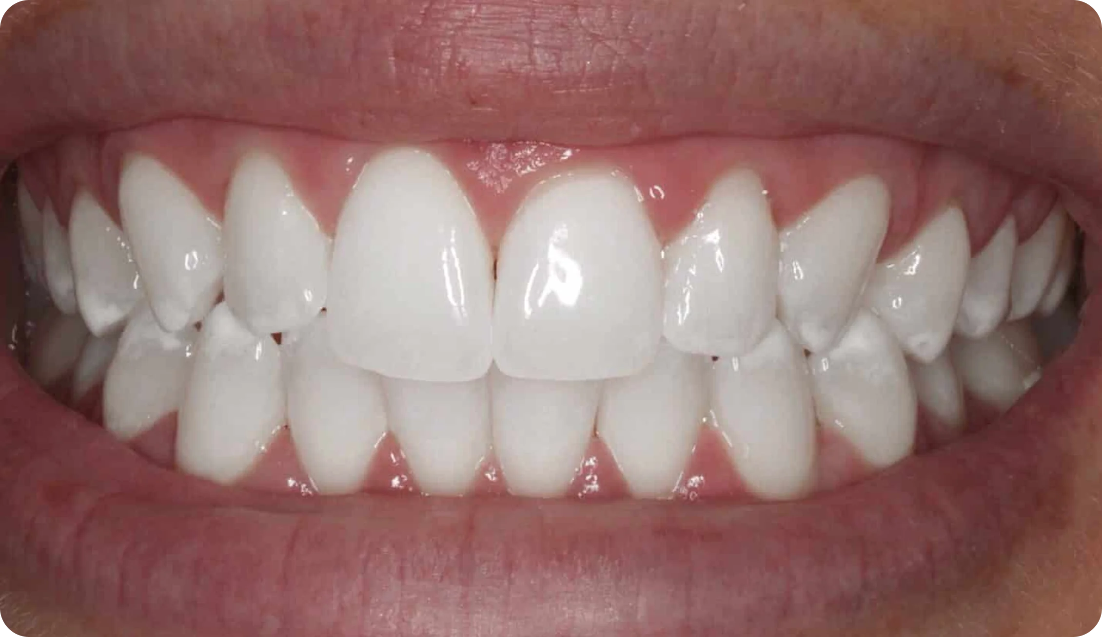 Teeth_Whitening_image_7
