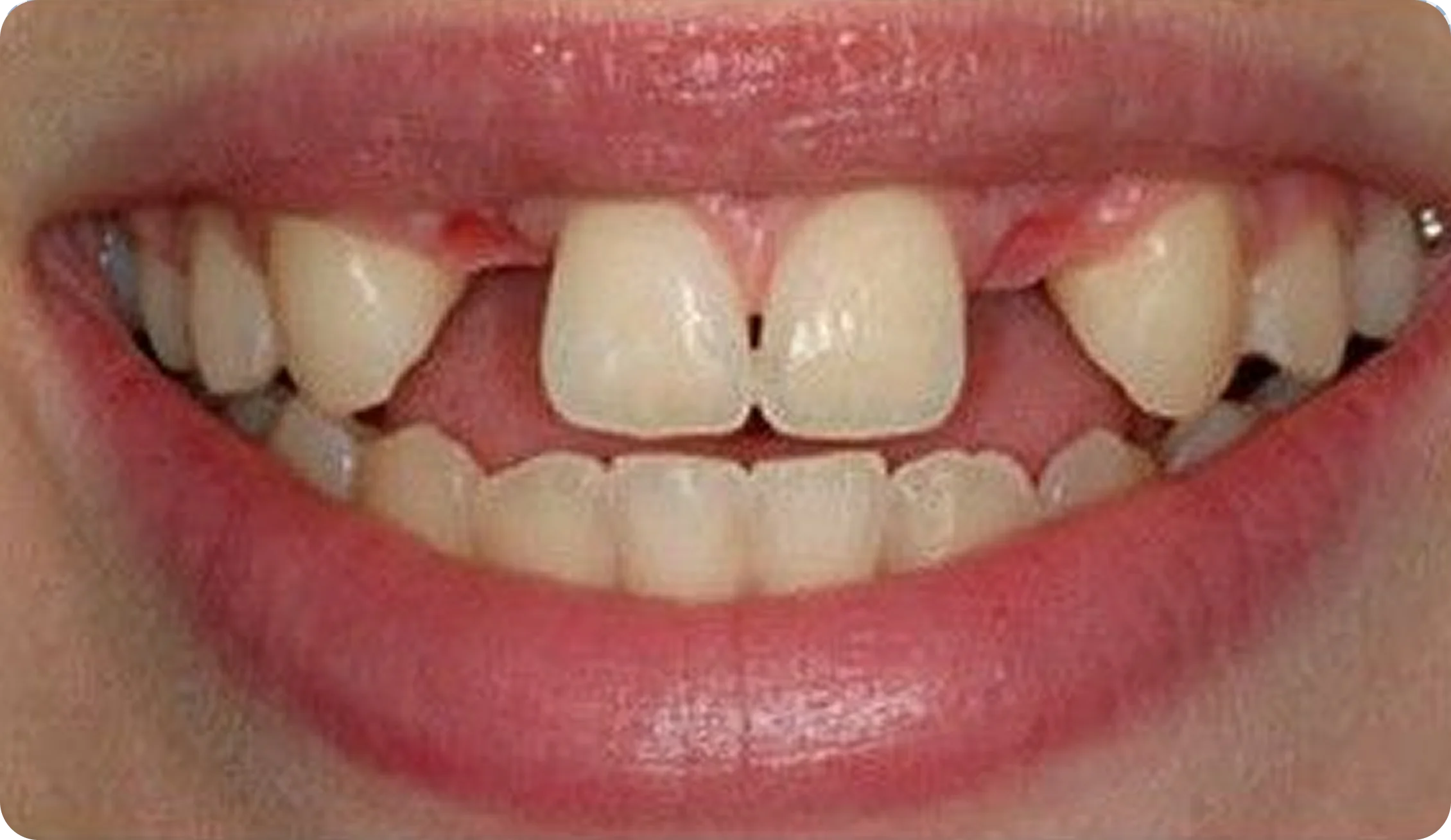 dental-bridges_image_6