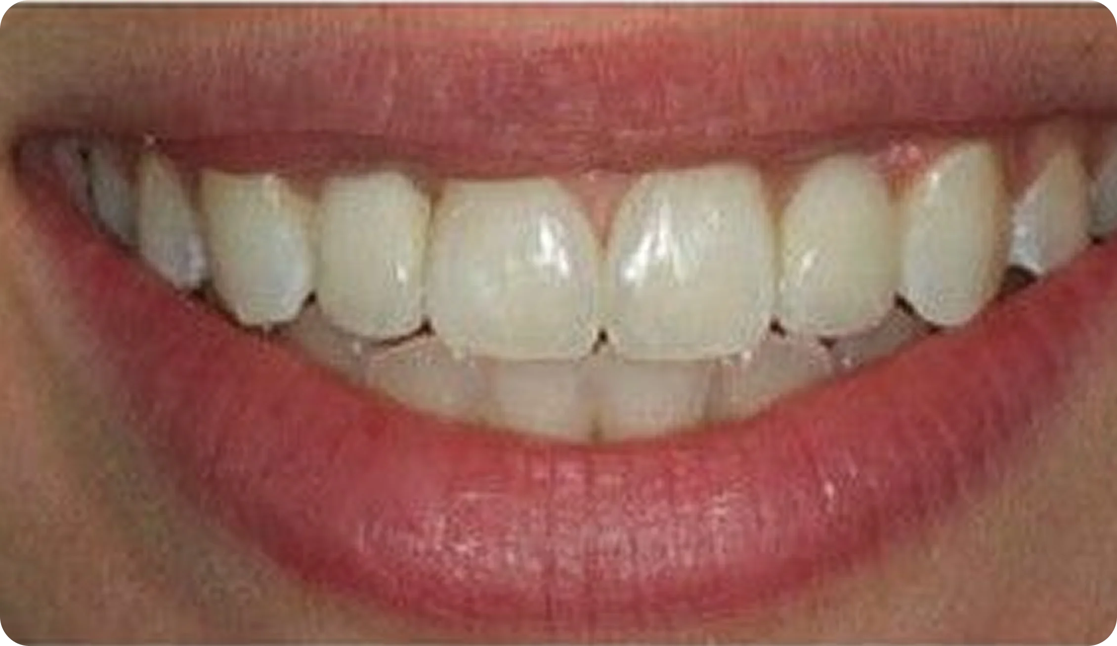 dental-bridges_image_7