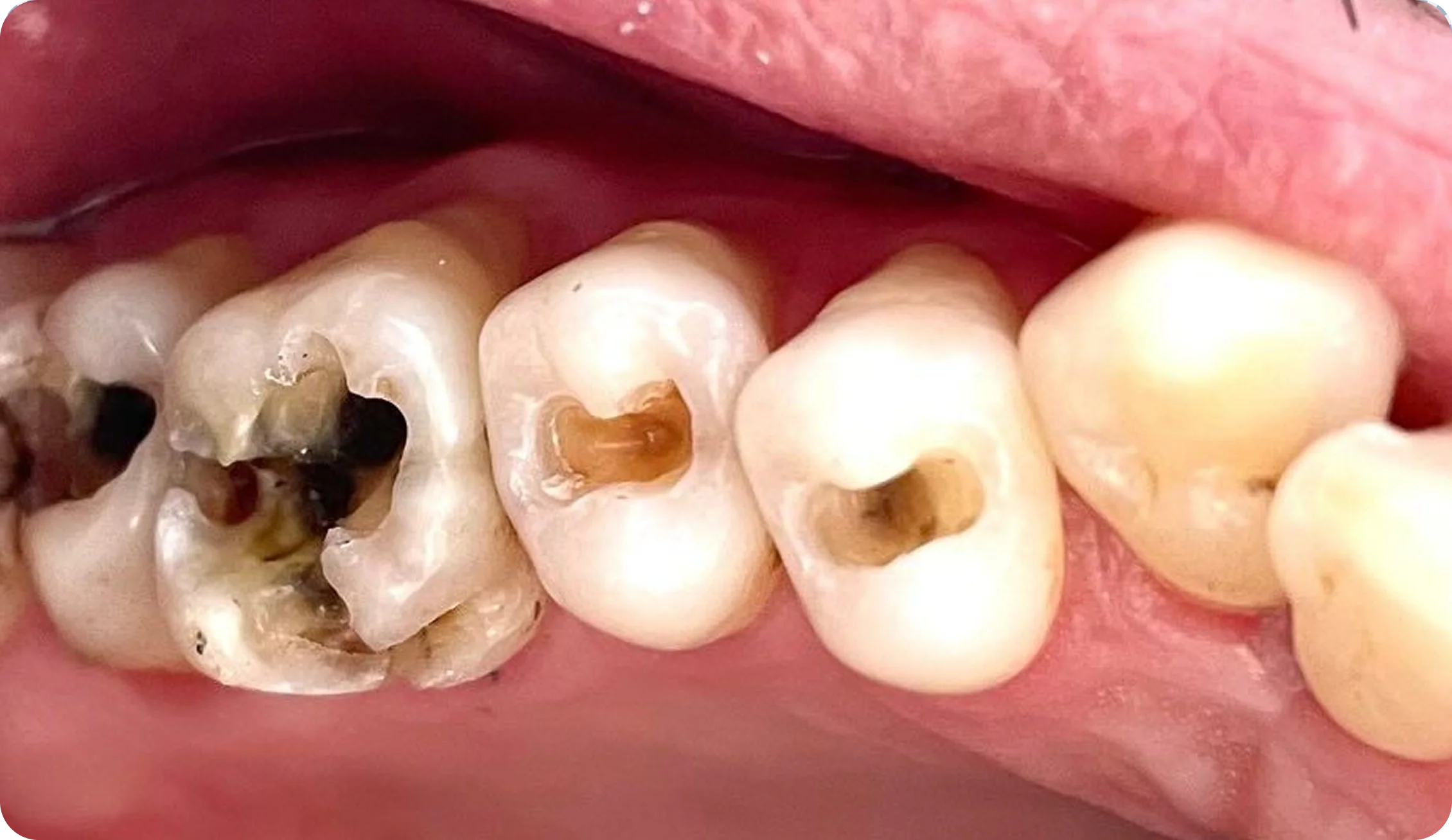 root-canal-treatment_image_6