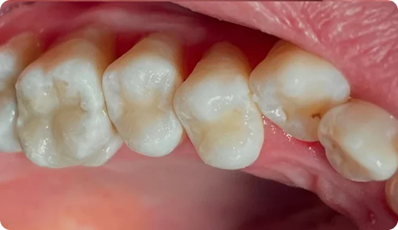 root-canal-treatment_image_7
