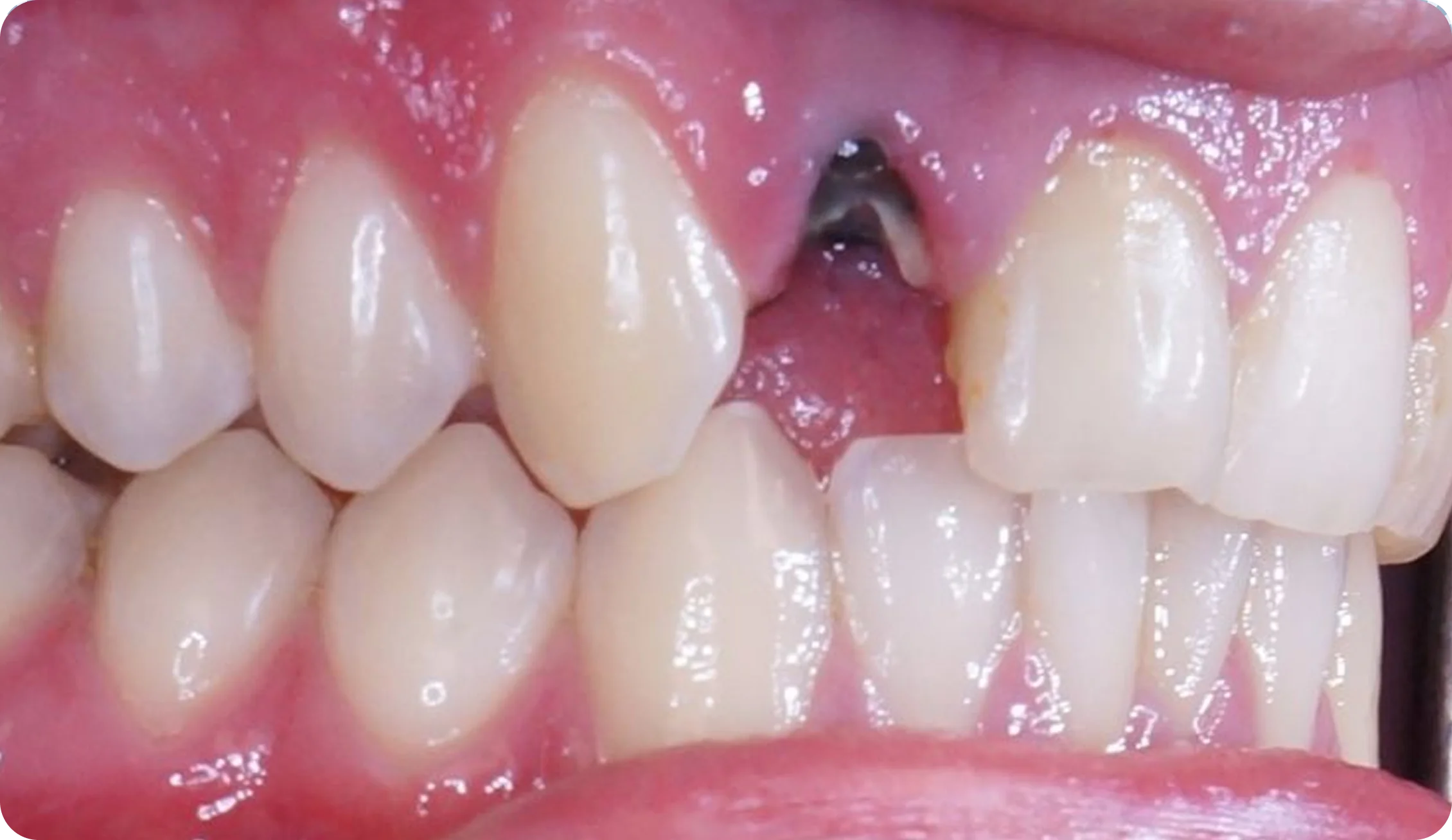 tooth-extractions_image_6