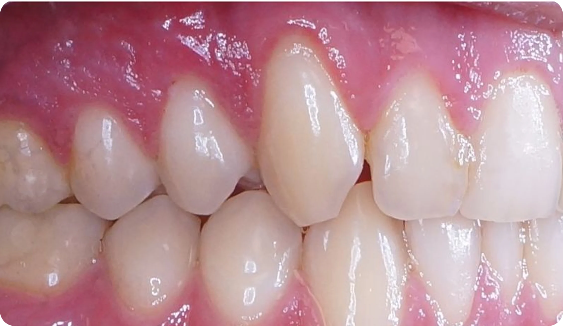 tooth-extractions_image_7