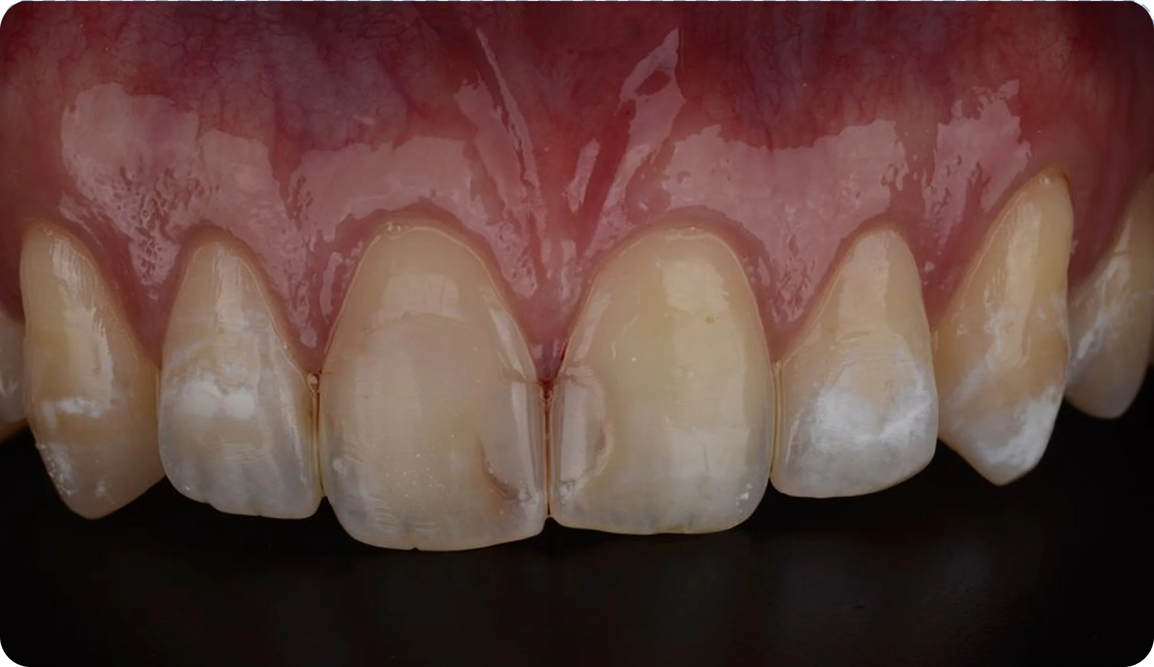 veneers_image_6