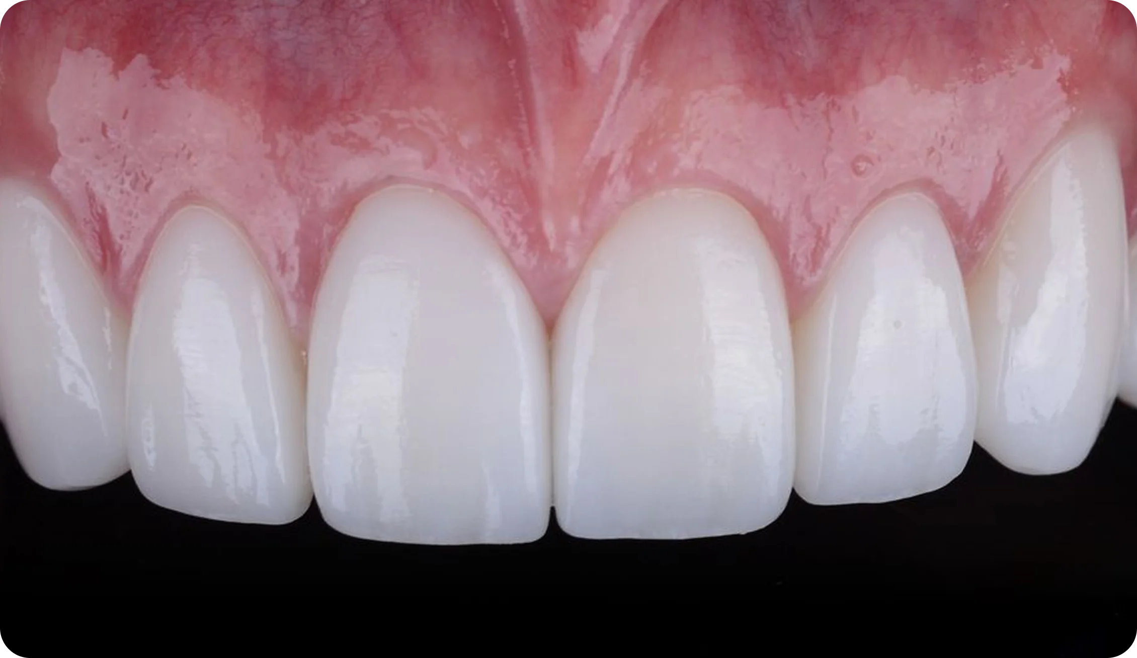 veneers_image_7